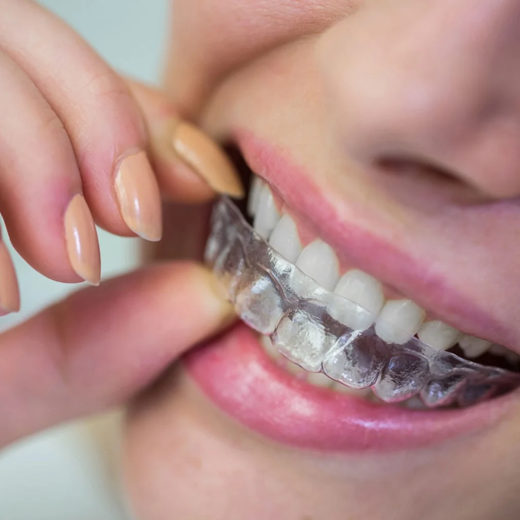 A close‑up view of a person placing a clear orthodontic aligner over their teeth.